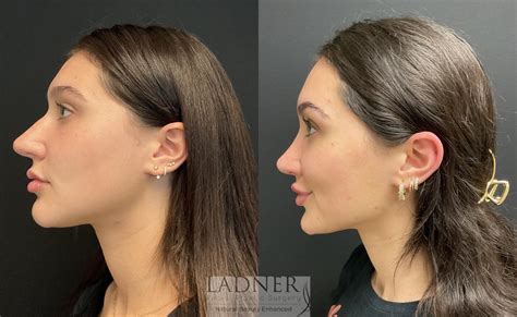 nose piercing after rhinoplasty|nose piercing after surgery.